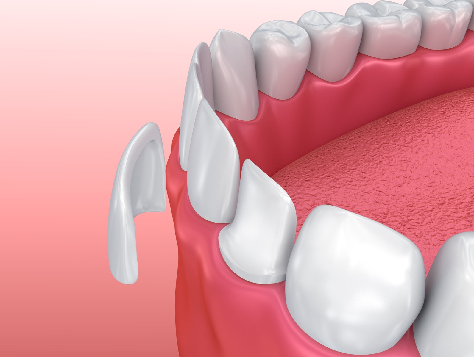 dental veneer in belton tx going on front tooth in mouth diagram